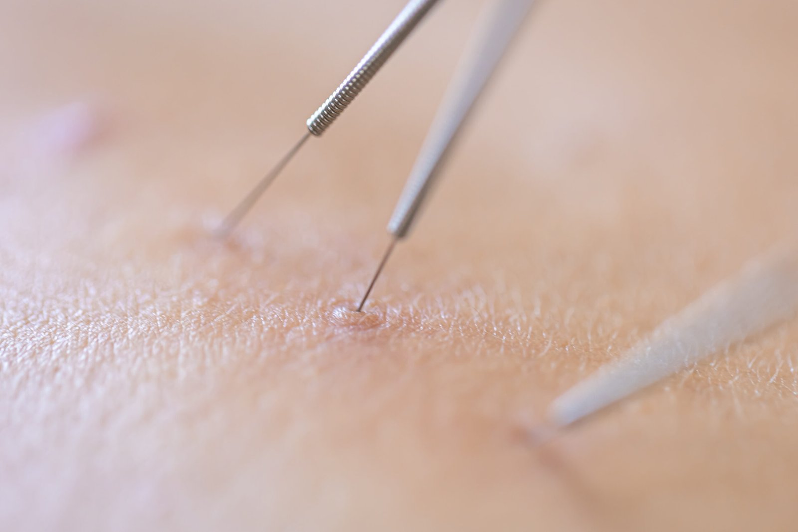 acne scar removal cost