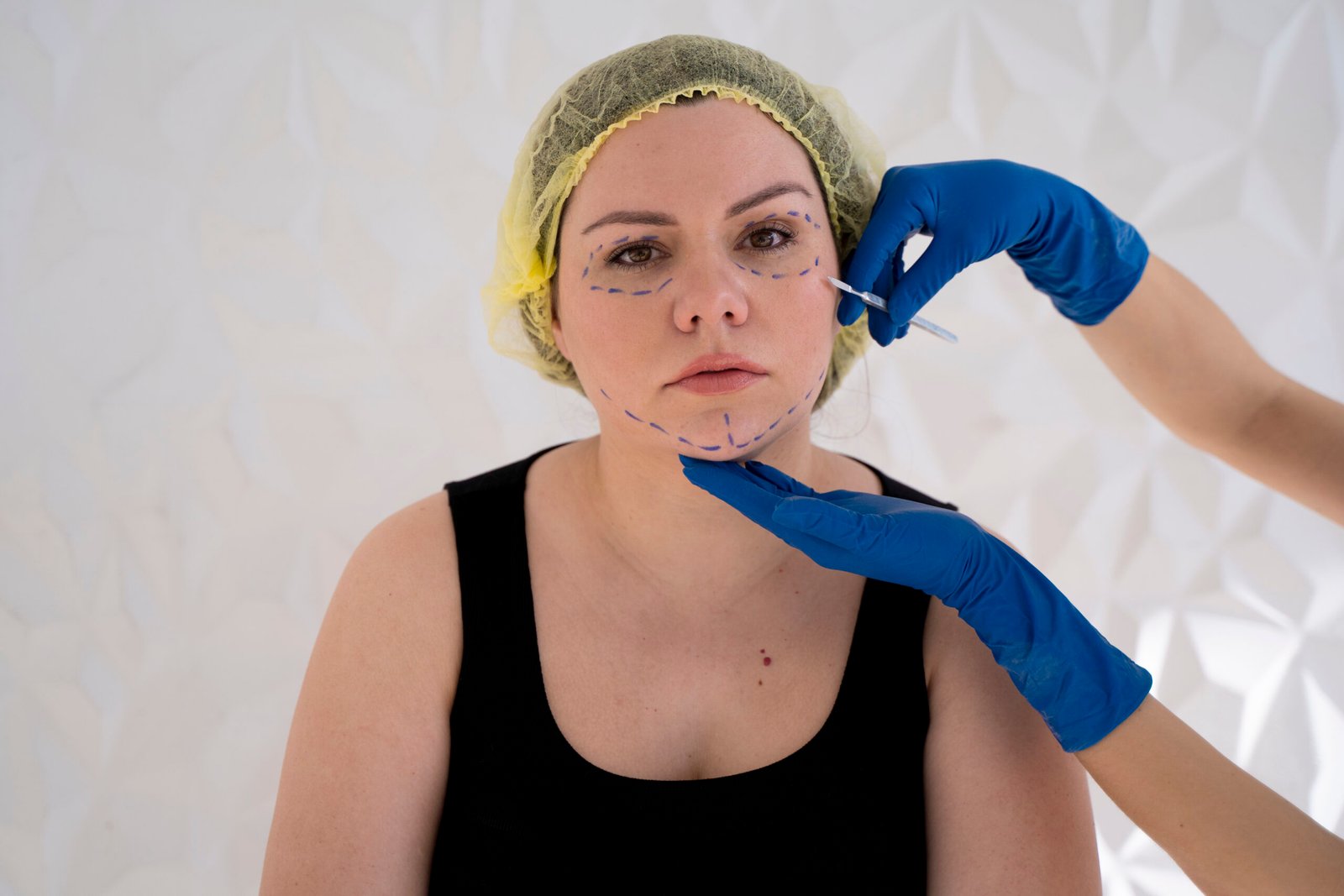 acne scar removal