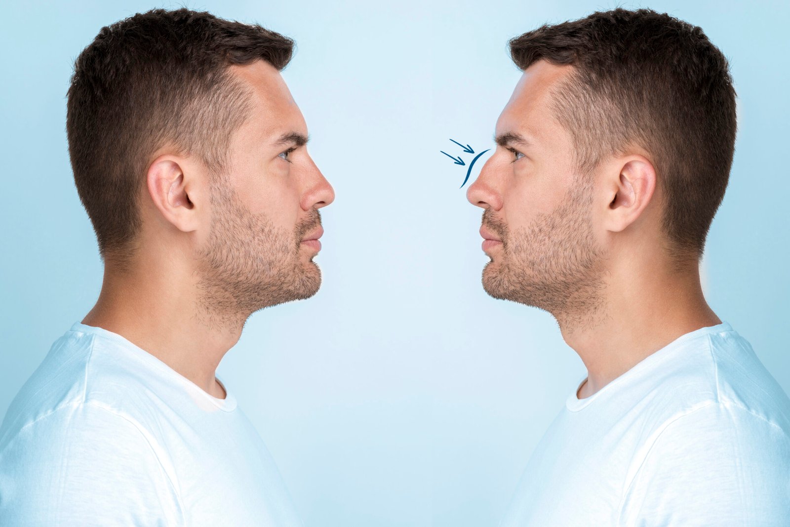 man-getting-ready-nose-job-surgery